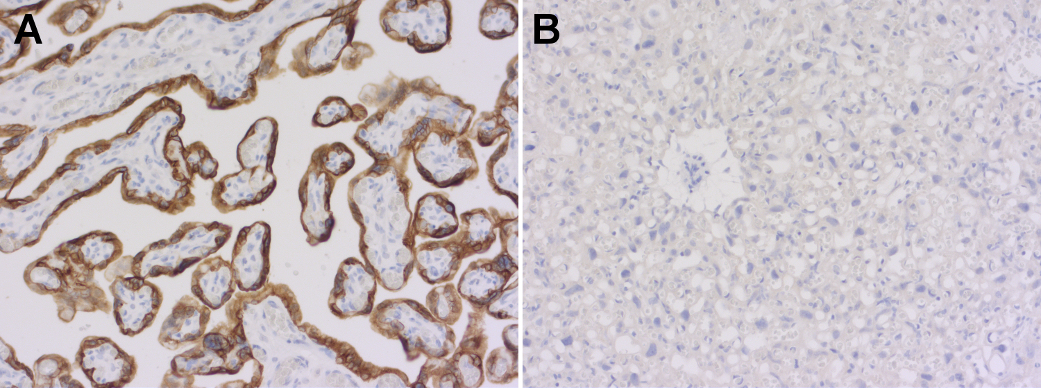 Cytokeratin 7 CK7 Scoring In Patient Derived Lung Xenografts